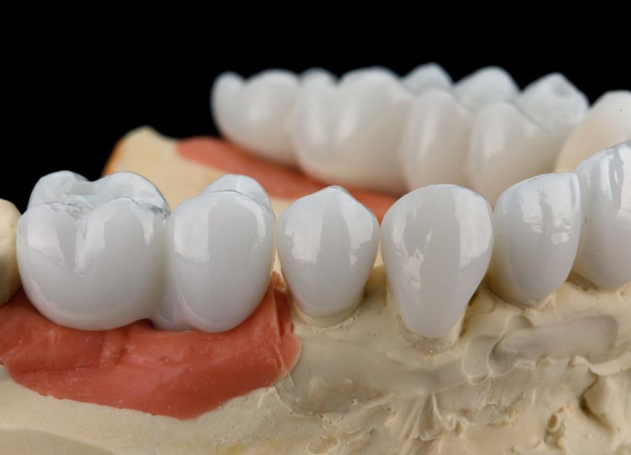 Porcelain Crowns and Bridges