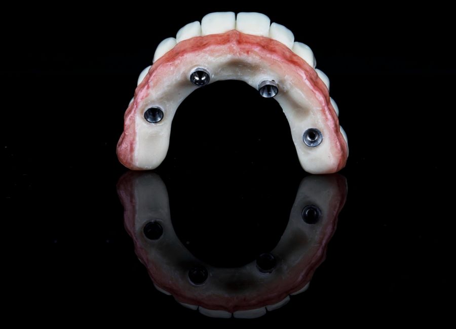 Implant-Supported Prostheses