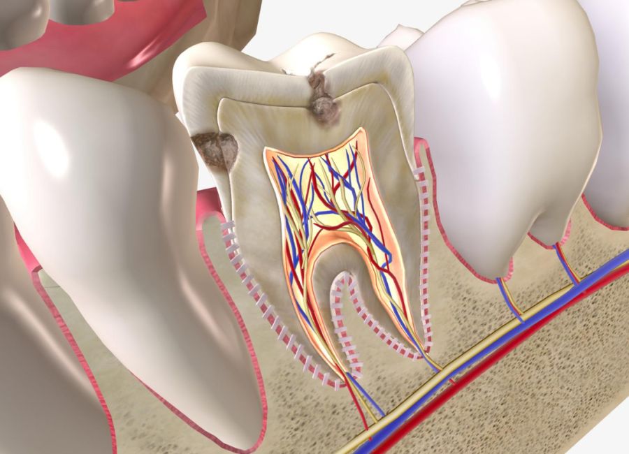 Retreatment (Root Canal Treatment Repetition)