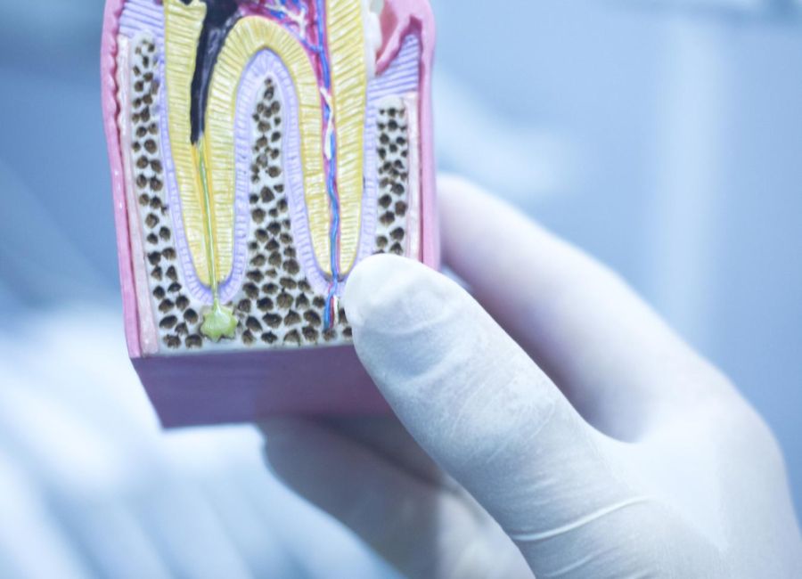 Root Canal Treatment