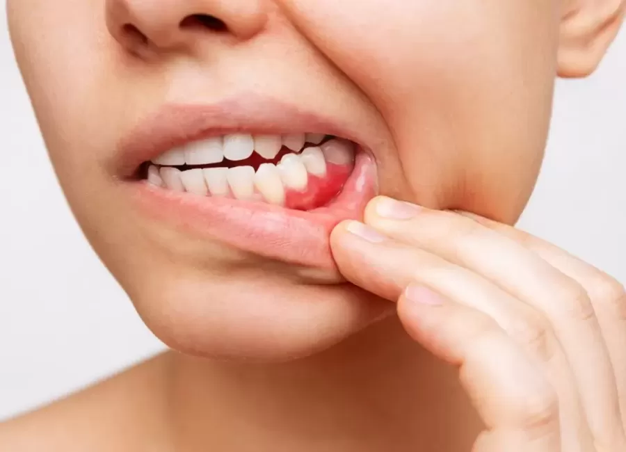 Treatment of Gum Diseases