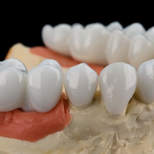 Porcelain Crowns and Bridges