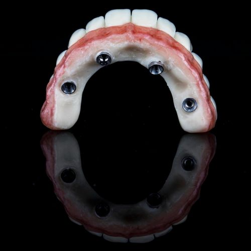 Implant-Supported Prostheses