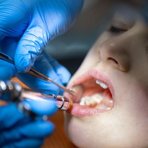 Süt Dişi Dolgu Tedavisi