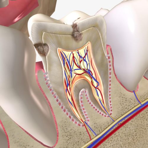 Retreatment (Root Canal Treatment Repetition)