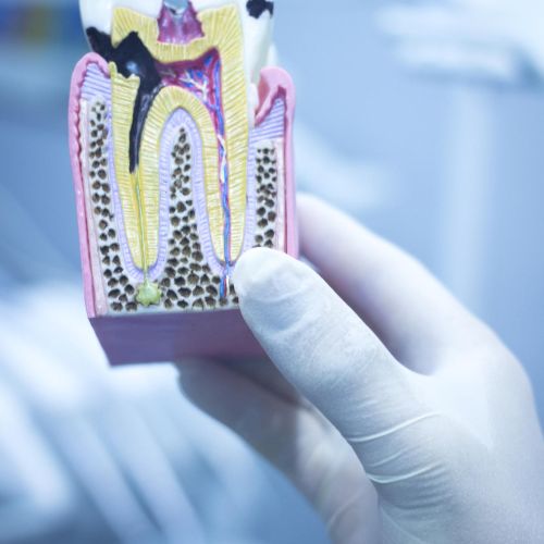 Root Canal Treatment