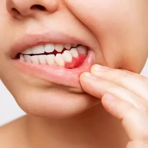 Treatment of Gum Diseases